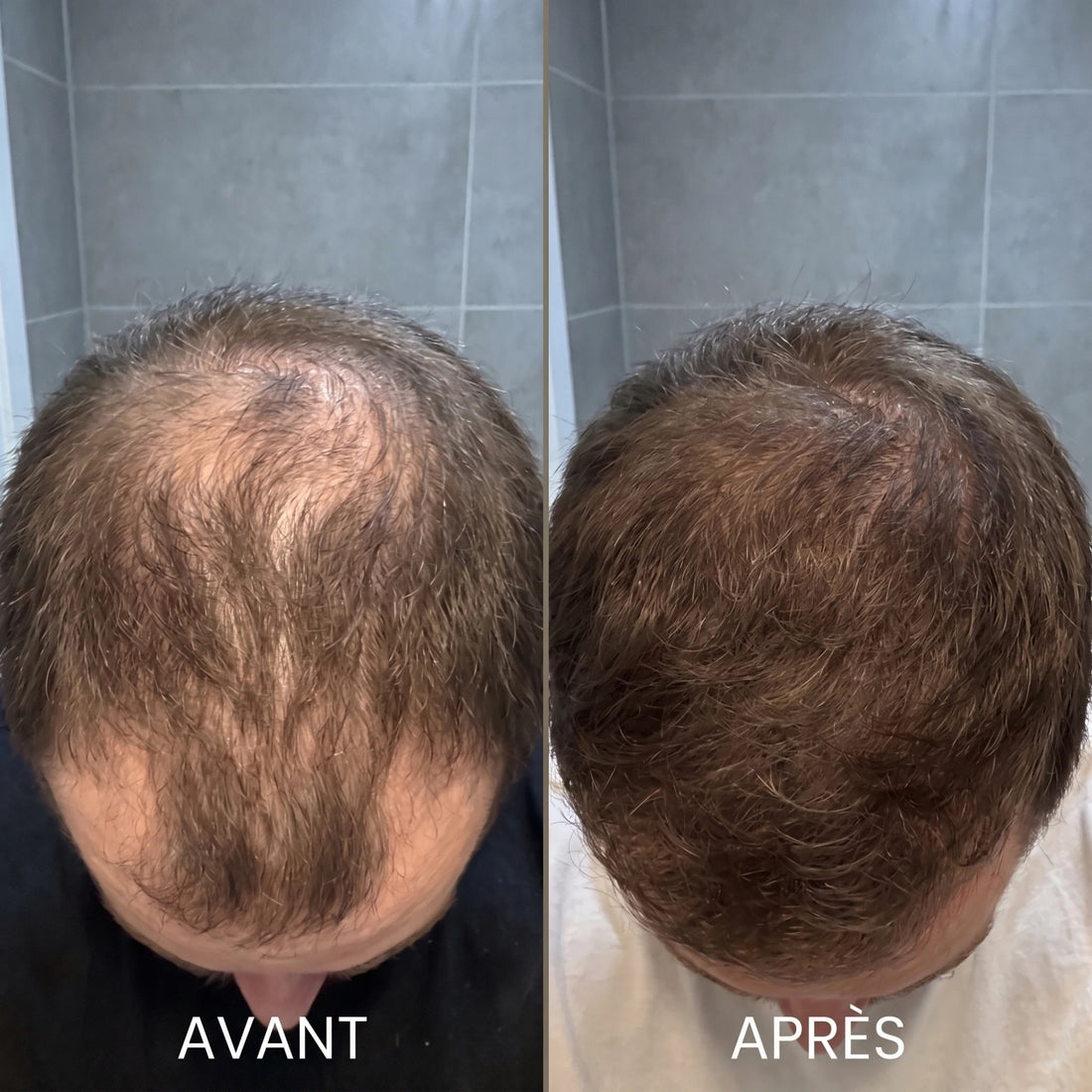 Avant après : vue du dessus du crâne
