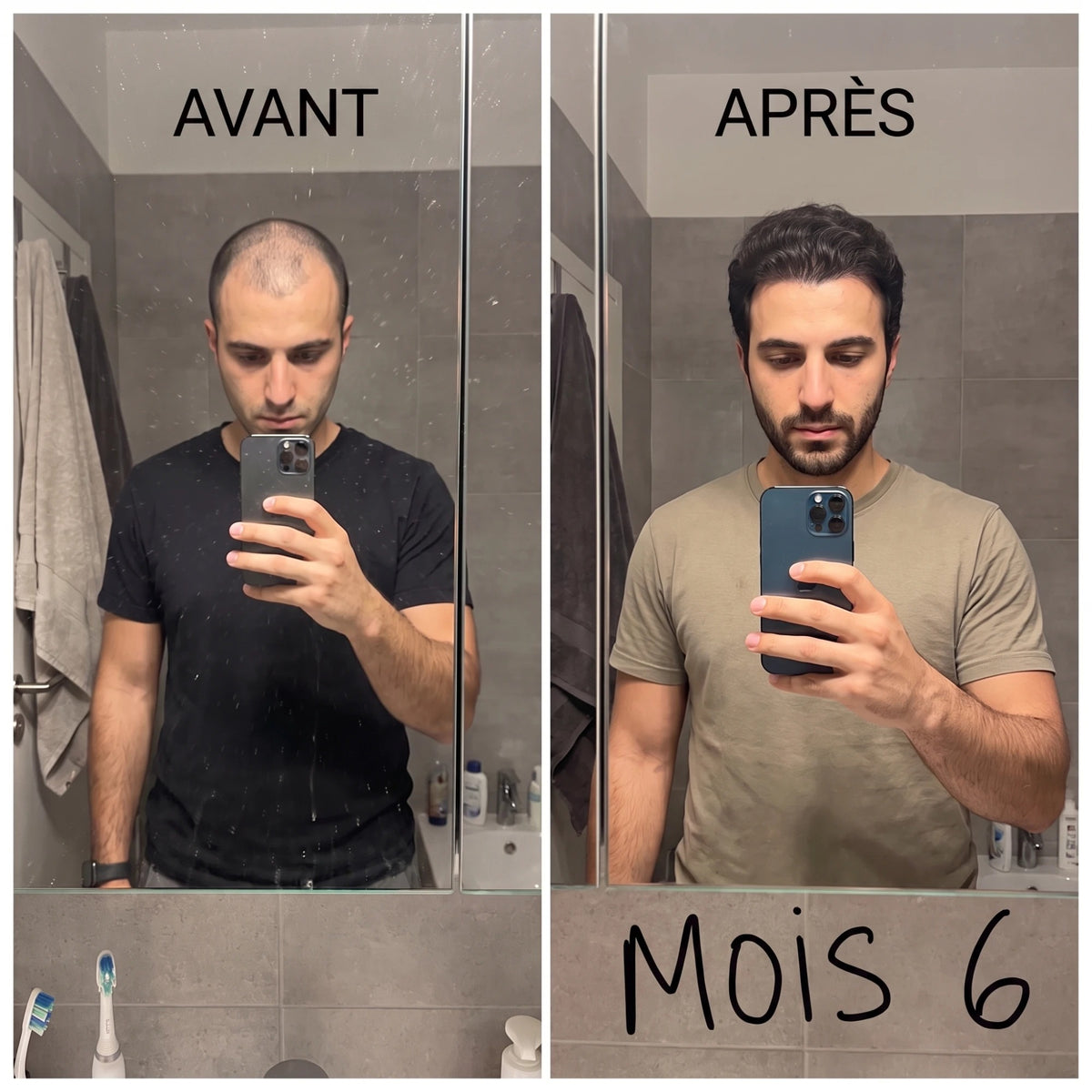 Avant après à 6 mois